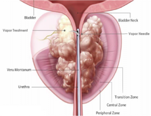 enucleation prostate surgery semnele de tratament ale prostatitei