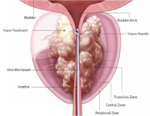 enucleation prostate surgery prostatita micotică