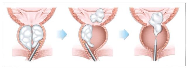 cáncer de próstata etapa 4 síntomas prostata operatie cu laser