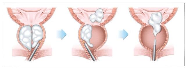 enucleation prostate with laser holmium